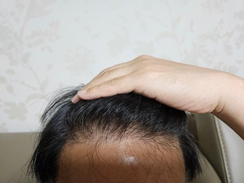 모재성 모발이식 3000모 8개월차 후기