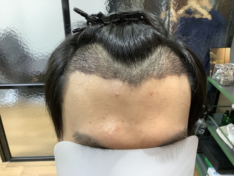 Here's the review of 4,000 hairs at the Jarada ClinicOh, my