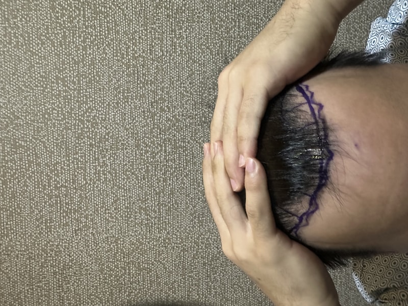 모발이식 후기입니다