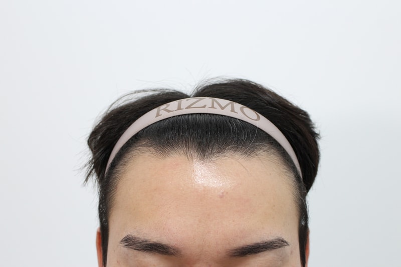 부산리즈모의원 모발이식 2주차경과