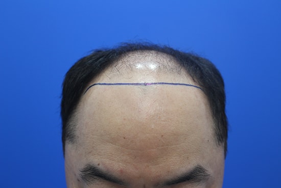 I transplanted 5,000 hairs.