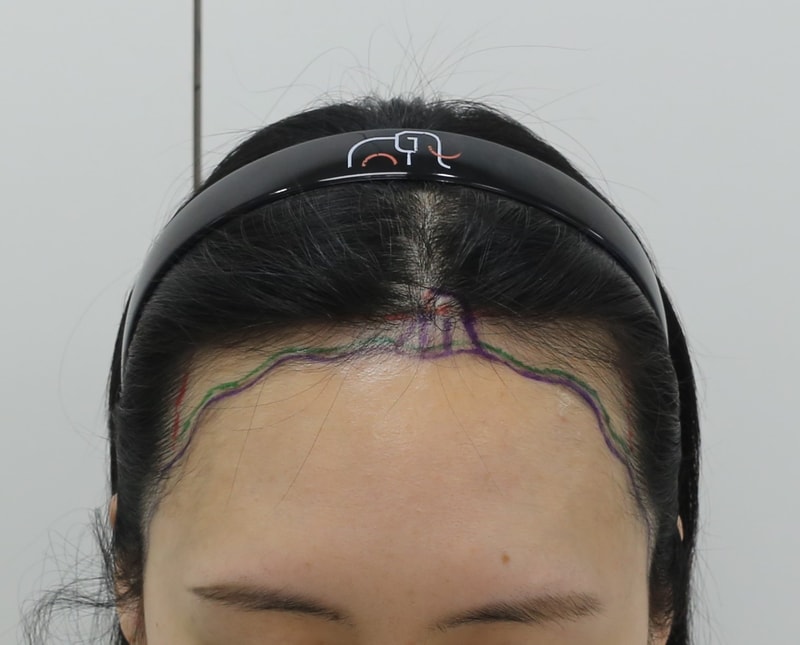 압구정 맘모스헤어라인 석지웅 원장님 7개월차 후기입니다