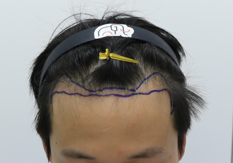Apgujeong Mammoth Hairline Hair Transplantation 2nd Week Review
