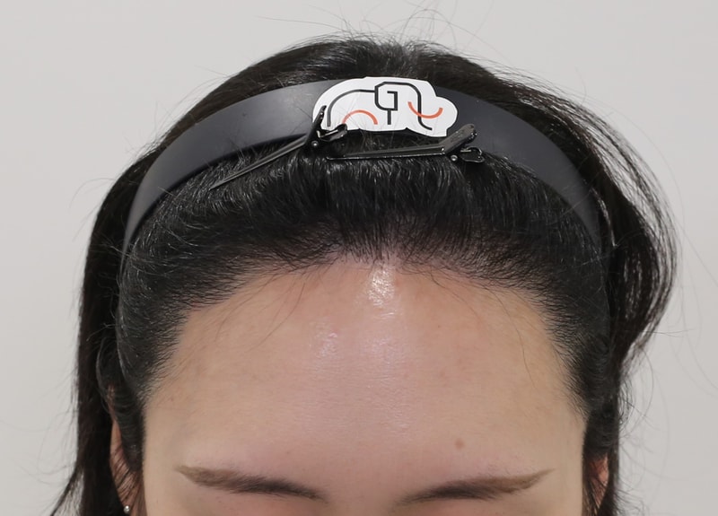 헤어라인교정 만족도 높은 수술이네요