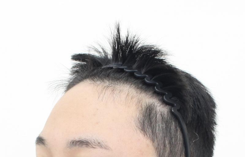 ★Mofro Clinic ★ Hairline Hair Transplantation Non-Cutting 2500 Mo 16th day elapsed
