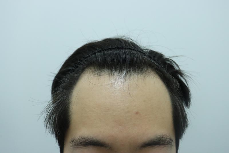 14일차 수술 후기