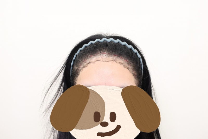 헤어라인 이식 재수술 14일차