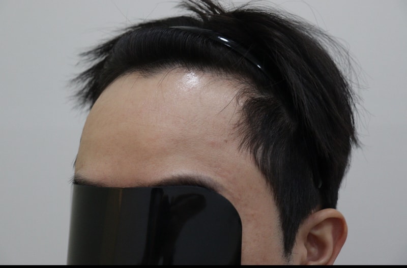 광주압구정모비앙의원 모발이식10개월 경과후기