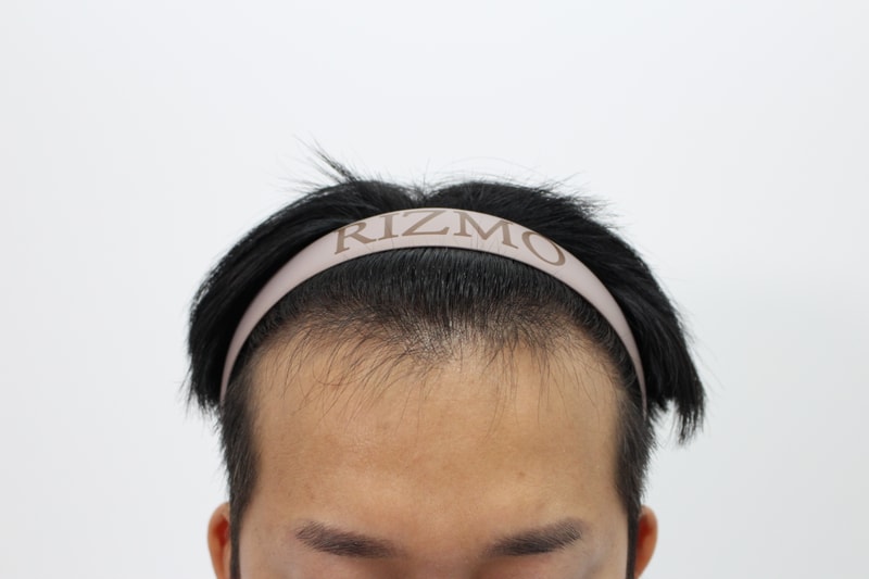 부산 리즈모의원 모발이식 2주차 경과