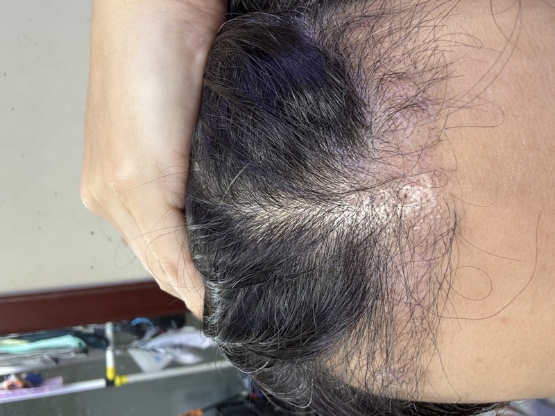 뉴헤어 절개 3200모 11주차 결과입니다.