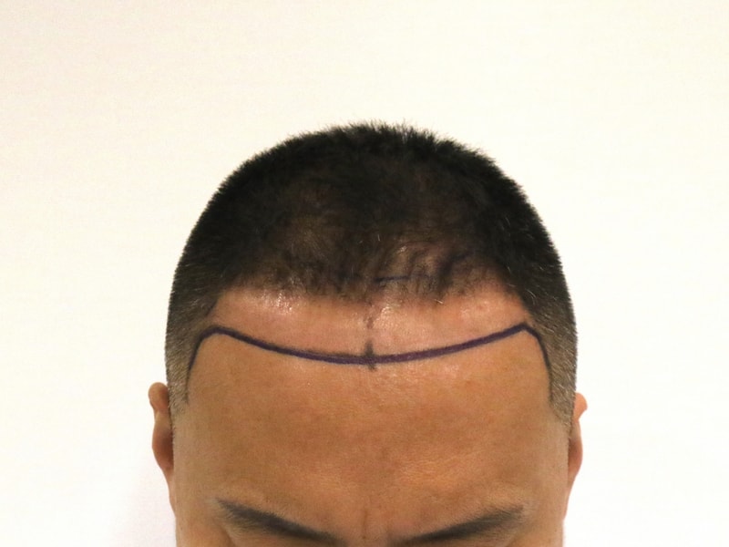 Busan hair transplant slit type Mammoth Hair Restoration Center M-shaped after 4 months.