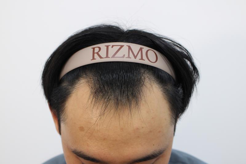 [Lizmo Medical Center] First Year Review of Non-Cutting Hair Transplantation