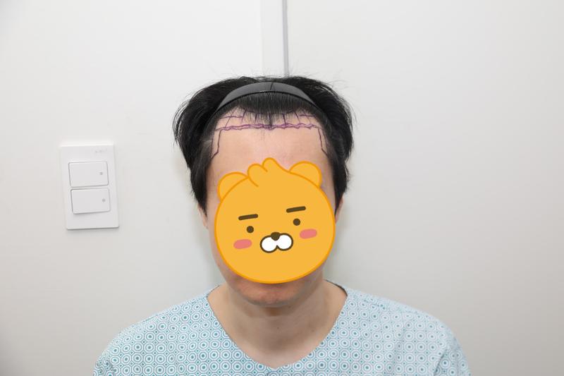 ニューヘアソウル 非切開 毛髪移植 1800毛包(3600毛) 6ヶ月目 レビュー