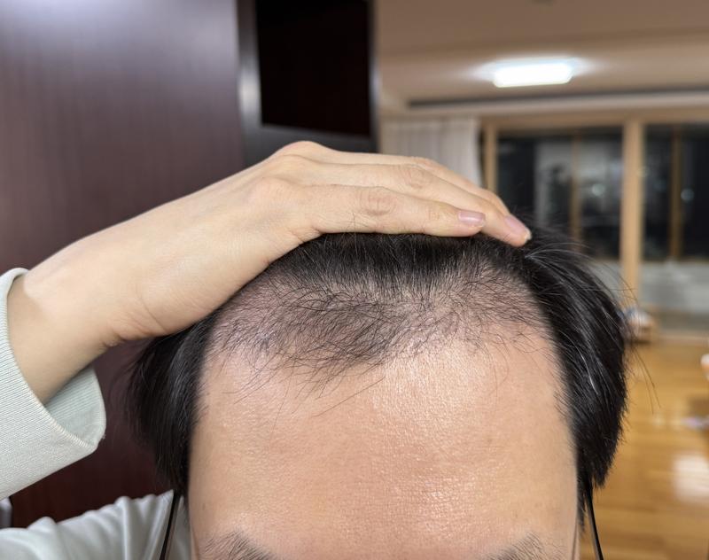 ニューヘアソウル 非切開毛髪移植 1800毛包(3600毛) 3ヶ月目 レビュー