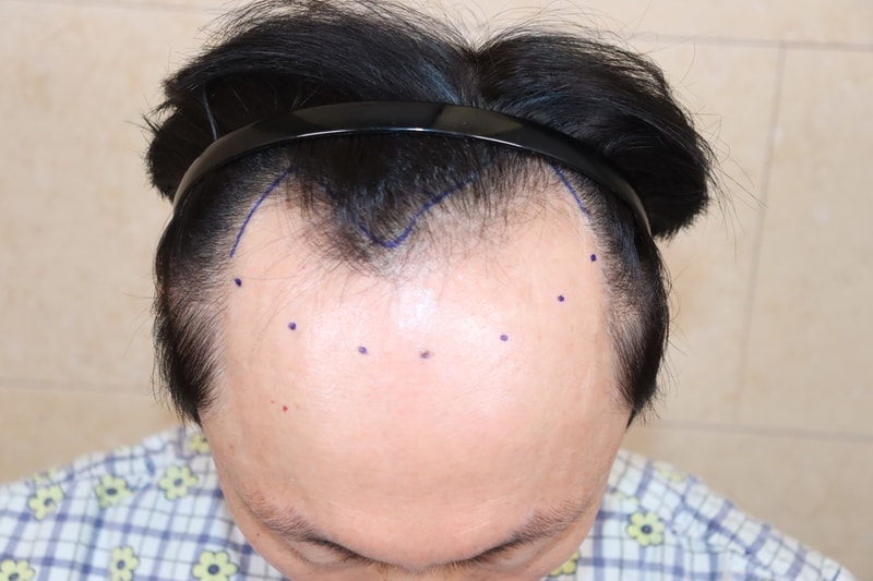 절개4500+비절개2500 혼합 모발이식 2일차(움찬의원)