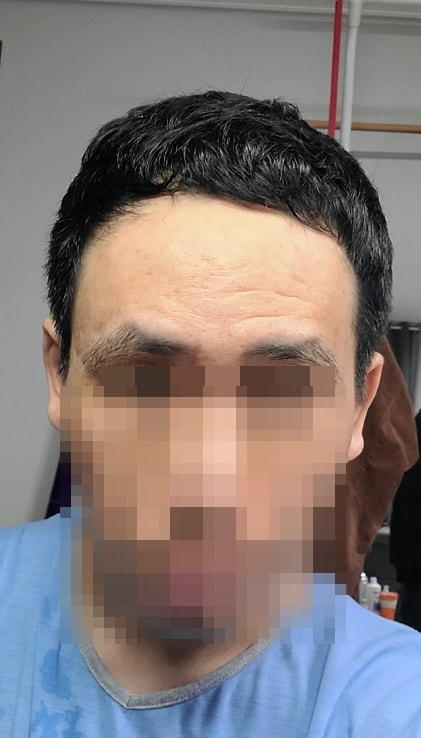 압구정맘모스 헤어라인 남성m자 모발이식 수술당일, 3일 후기
