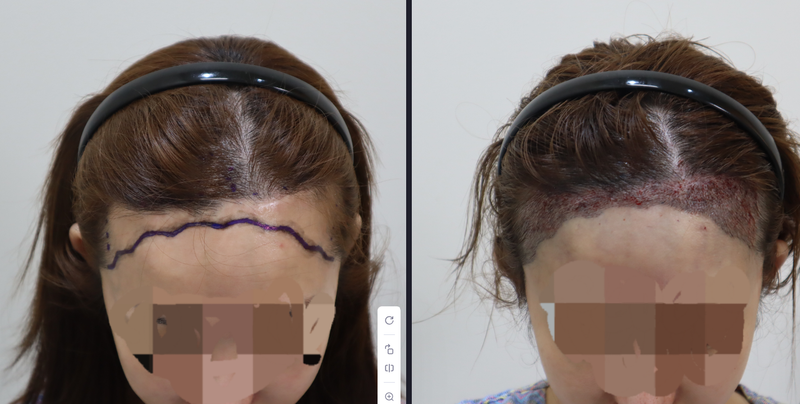 バンス モザイナー 医院 切開植毛 体験談