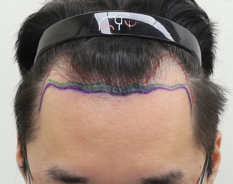 狎鸥亭猛犸发际线诊所非切开毛发移植后记（笑声气体麻醉）