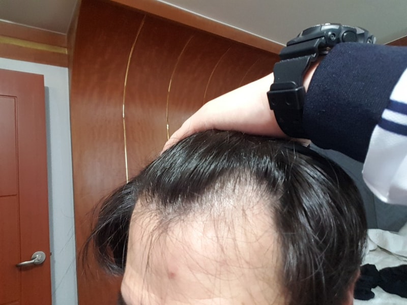 수술전`.jpg