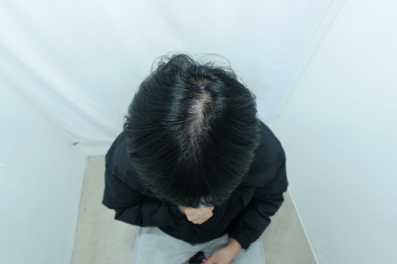 자라다의원 가르마라인 비절개 모발이식 1일차 후기