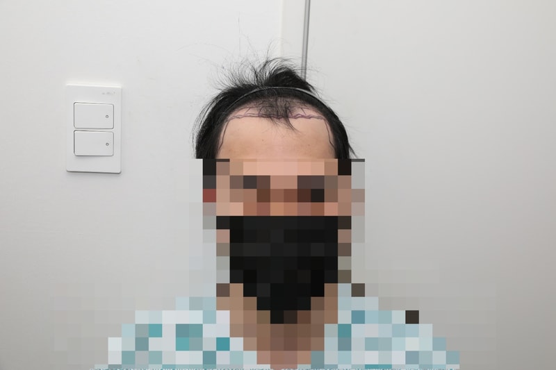 New Hair Seoul branch incision hair transplant 2200 hair follicles (4,400 hair) 10 months later