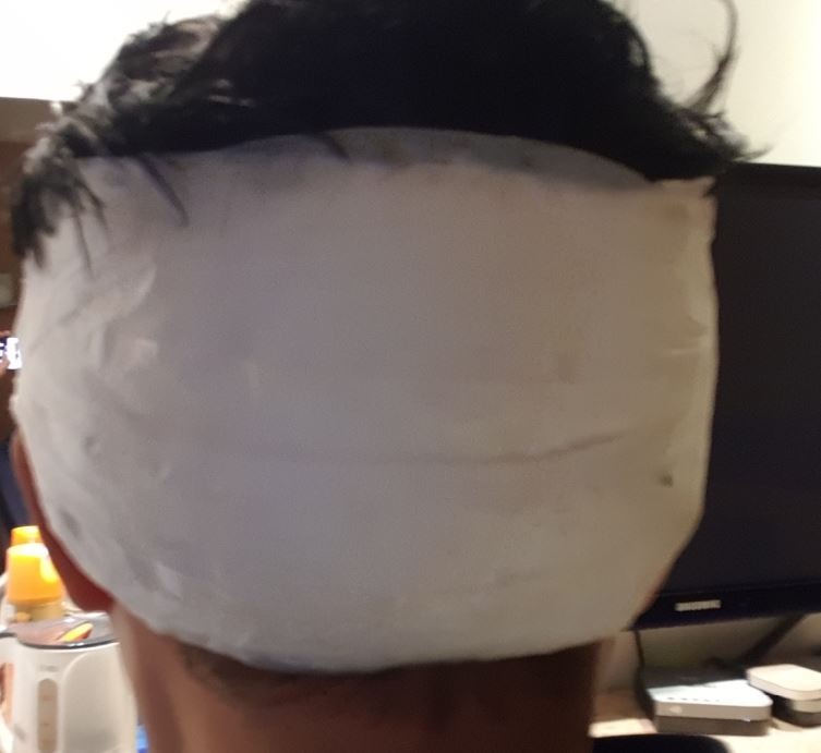 모발이식 후3.JPG