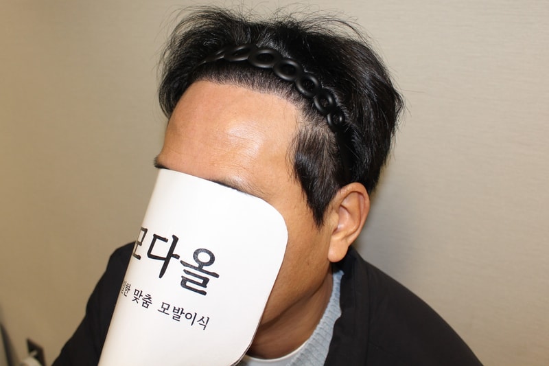 6개월경과 왼쪽.jpg