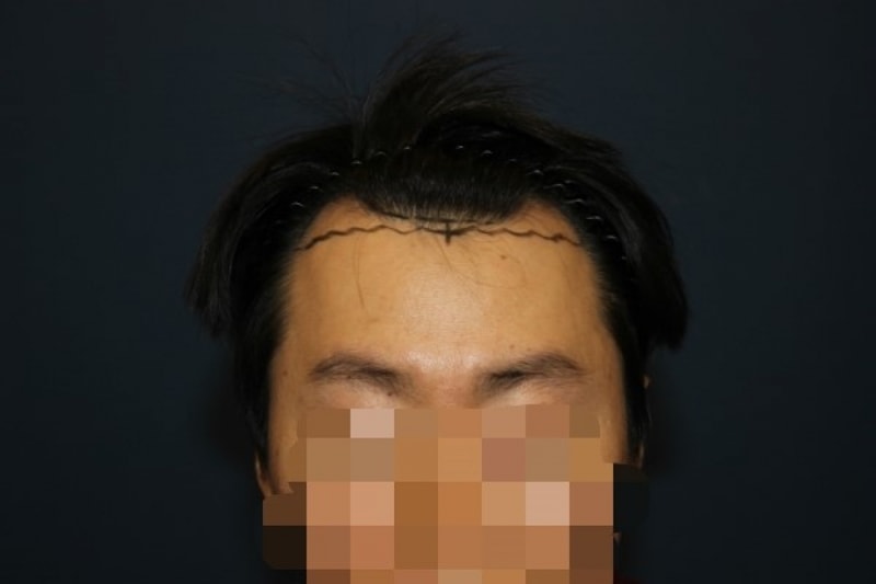 수술전.jpg