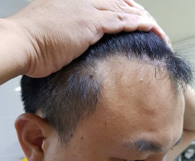 ポヘア 6ヶ月 1600毛包 左右別に撮ってみました