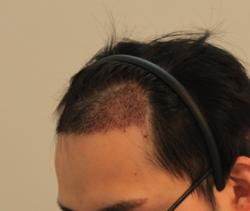 Forehead March 7th Monthly Surgery Evaluation