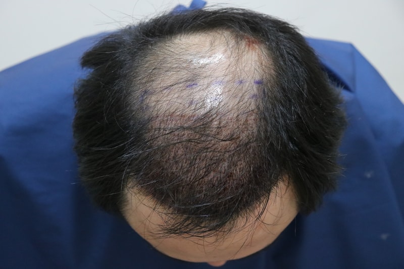 수술다음날 4.JPG