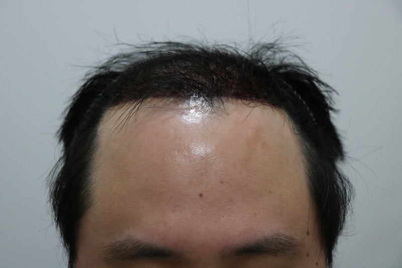 수술다음날 2.JPG