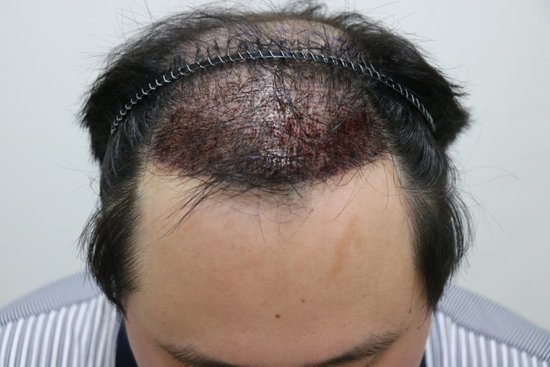 수술다음날 1.JPG
