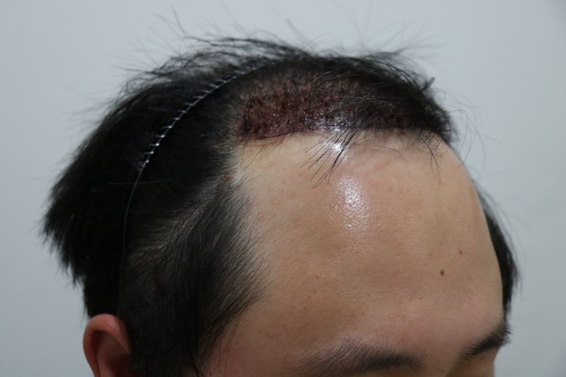 수술다음날 3.JPG