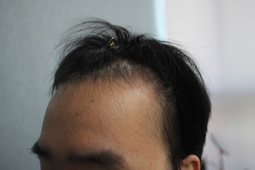 이식전2.jpg