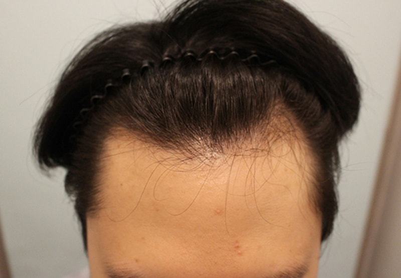 Dr. M-shape/Asymmetric Line 2400 Mo 3 months
