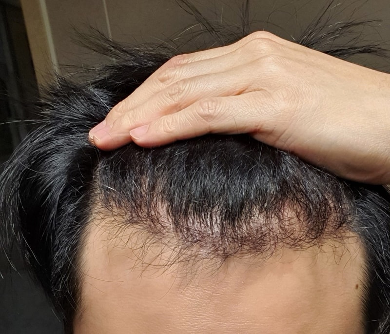 New hair non-cut 1600 hair follicles (3200 hair) 169th day elapsed