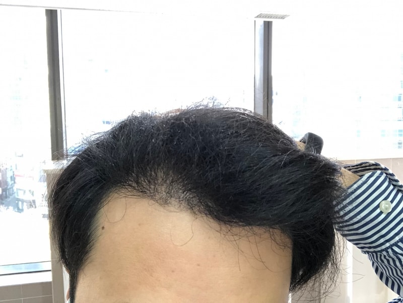 (Evaluation please) New hair non-cut 1600 hair follicles (3200 hair) 260 days have passed (8 months and 16 days)