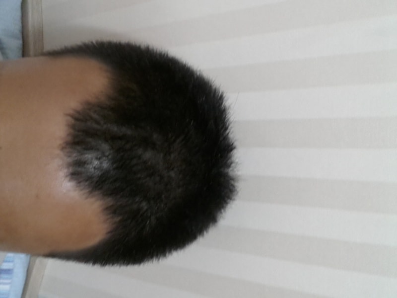 FOHAIR M字800 毛囊移植第3天后期