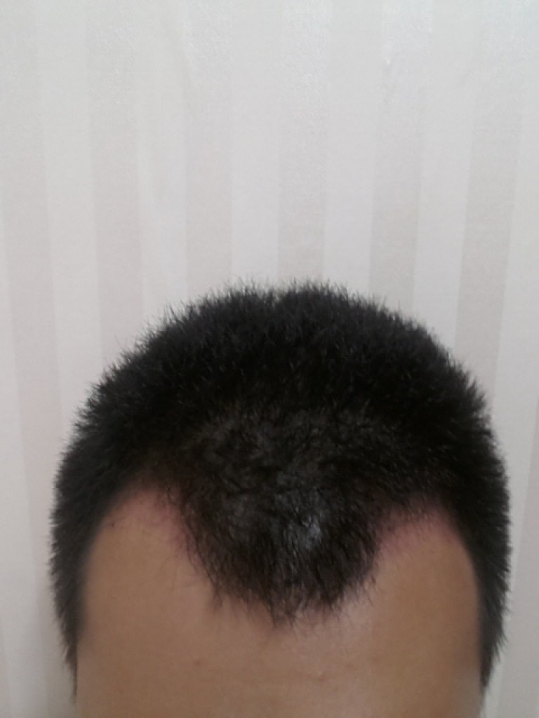 FOHAIR M字800毛囊移植第2个月后期