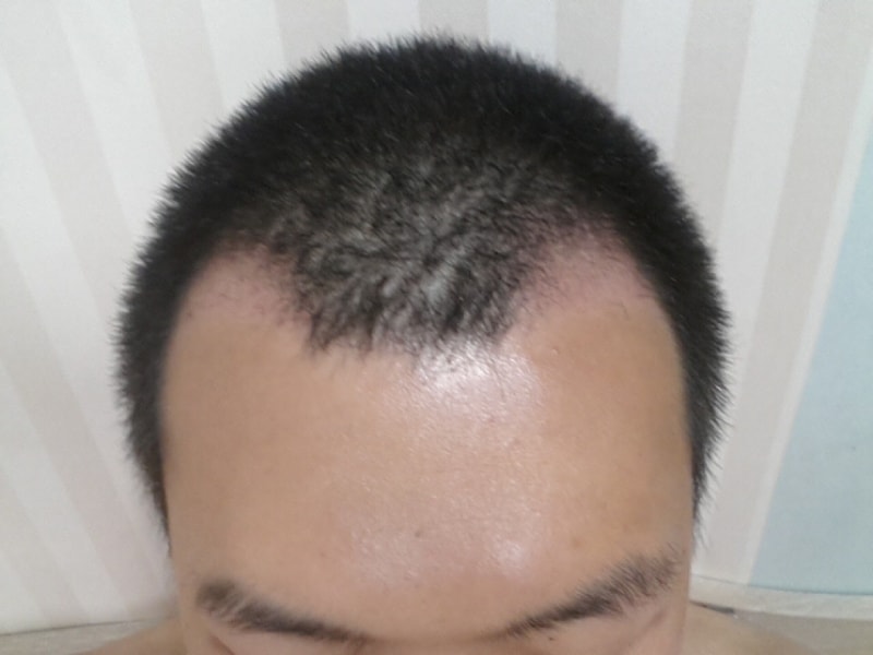 FOHAIR M字800毛囊移植第1个月后期
