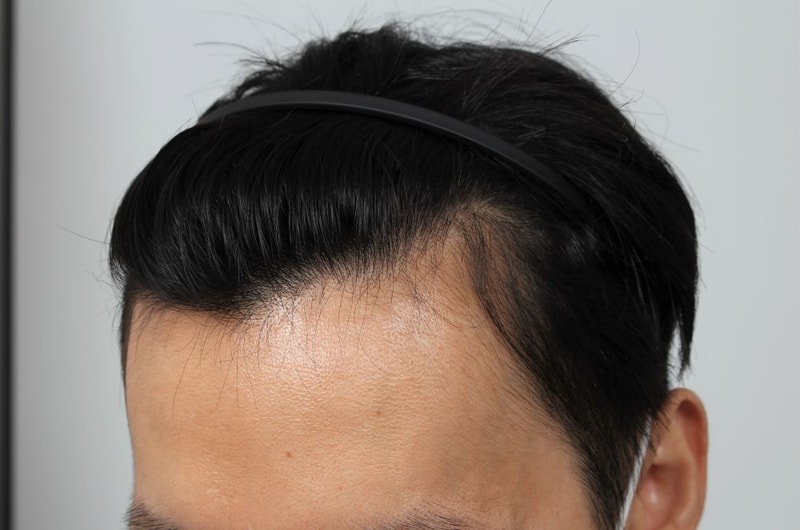 Busan Non-Cutting Hair For Hair Busan Branch M-shape 2nd Week