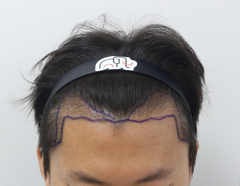 수술 전.jpg