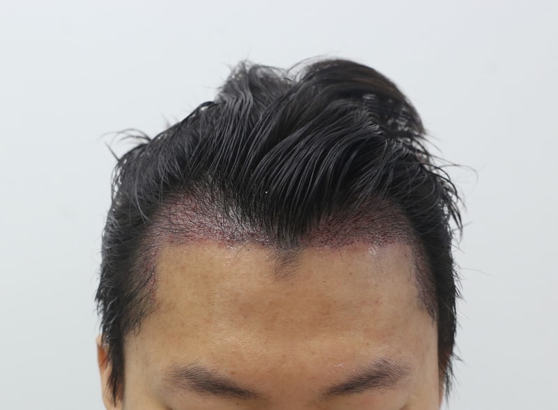 수술 후.jpg