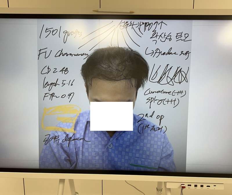 This is a review of mammoth reoperation after the first failure of diffuse hair loss surgery.