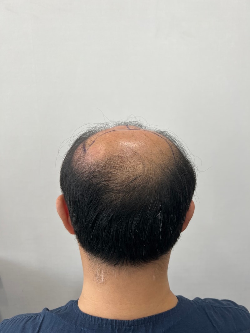 수술전_뒤.jpg