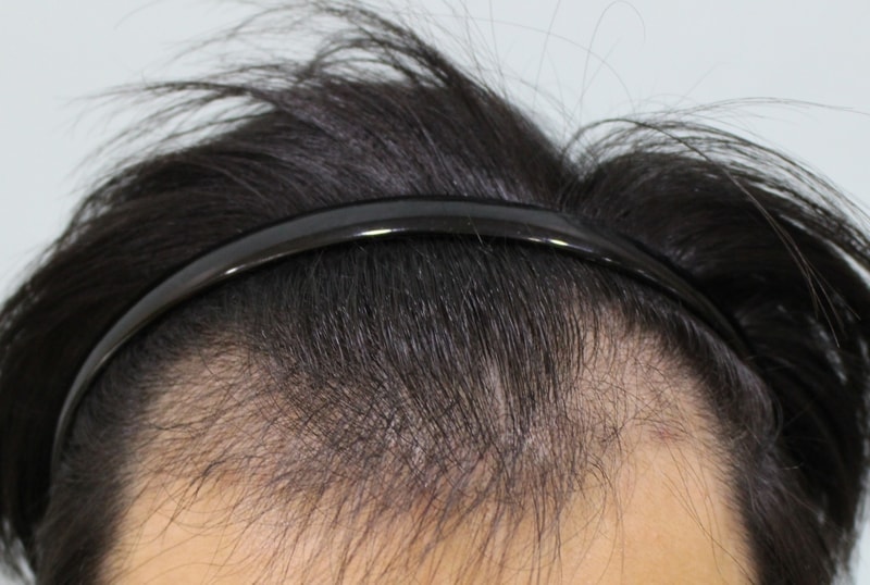 Three months after the operation