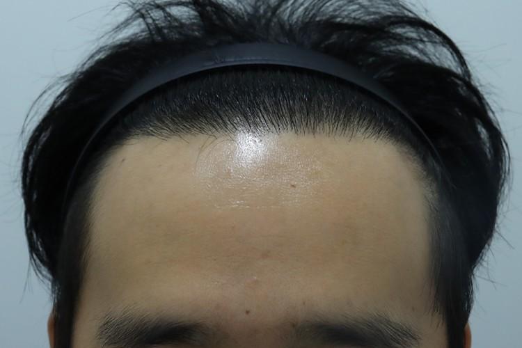 4900모 모먼트의원 히든컷 9개월