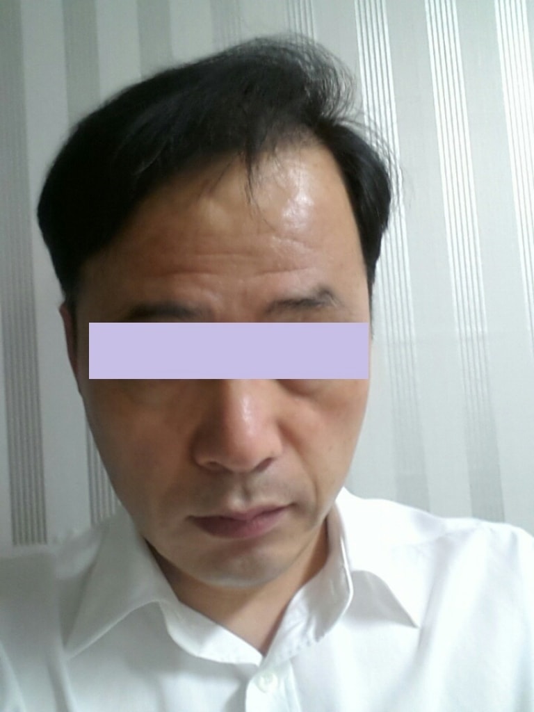 수술후18개월01.jpg