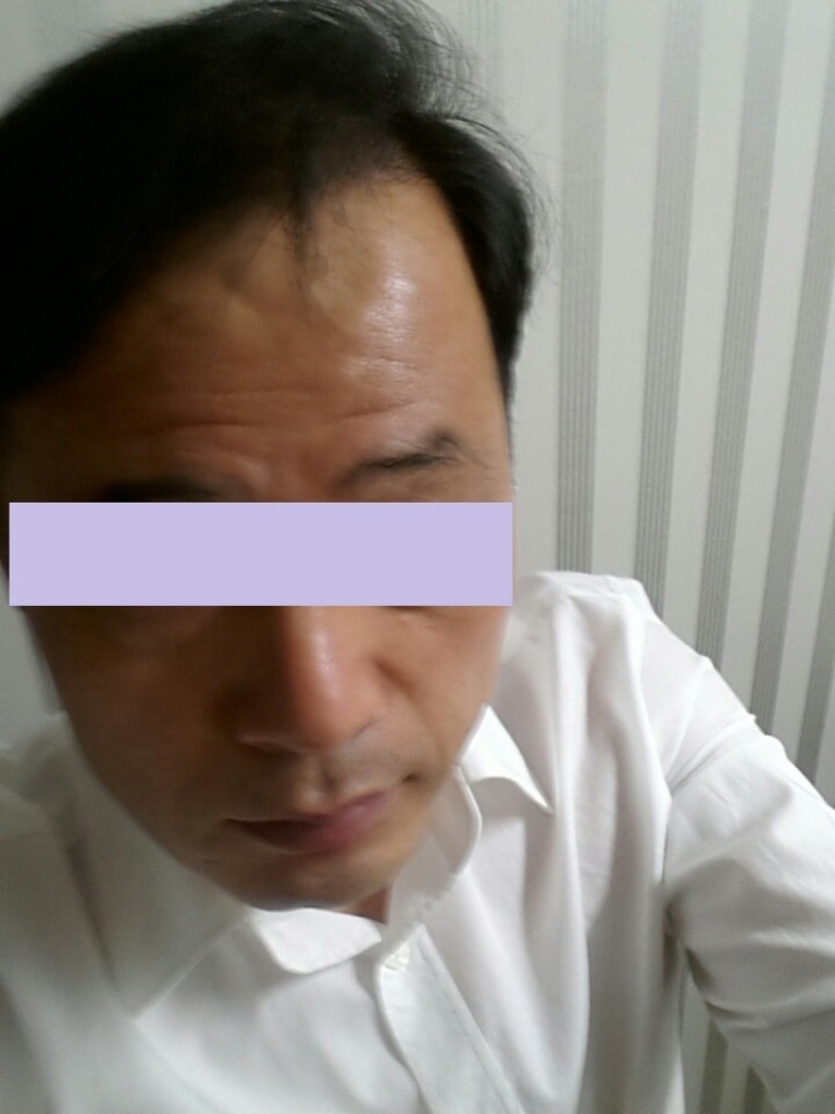 수술후18개월02.jpg